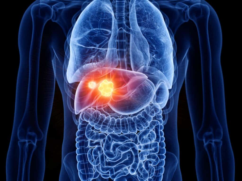 Fatty Liver | mindbodysoul holistic health
