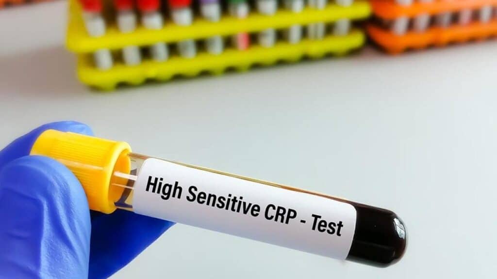 Inflammation & High Sensitivity-CRP (hsCRP)